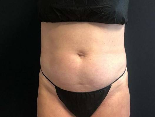 Laser Lipo - Carmel Before