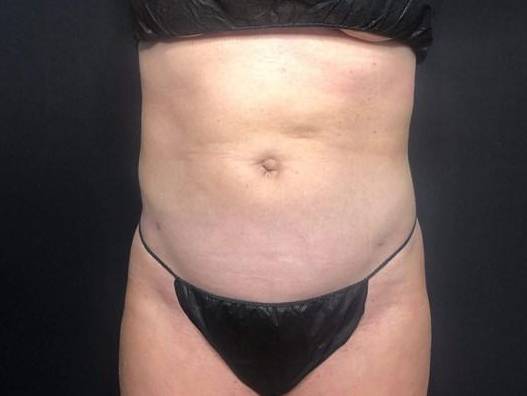 Laser Lipo - Carmel After