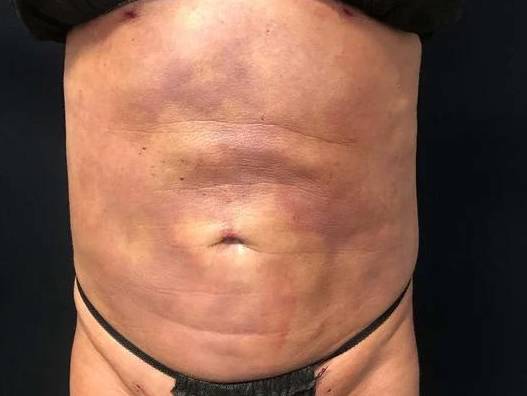 Laser Lipo - Carmel Case 2 After