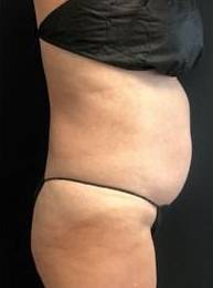 Laser Liposuction Before