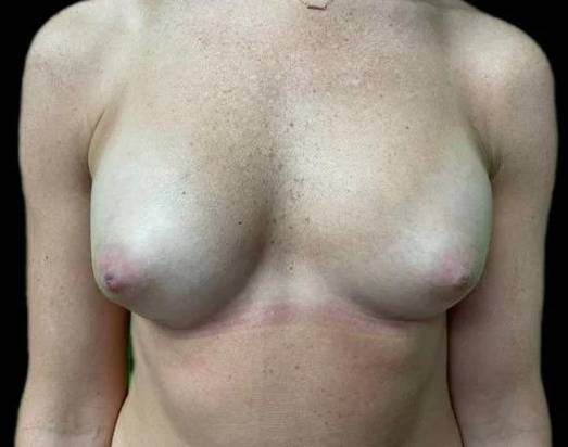 Fat Transfer to Breasts After