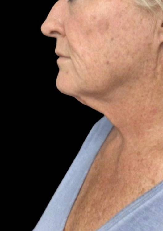 61 year old wanted to get rid of unwanted fat under her chin- Terre haute, IN Before