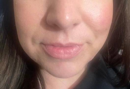 33 year old Before and After Lip Filler, Carmel, IN Before