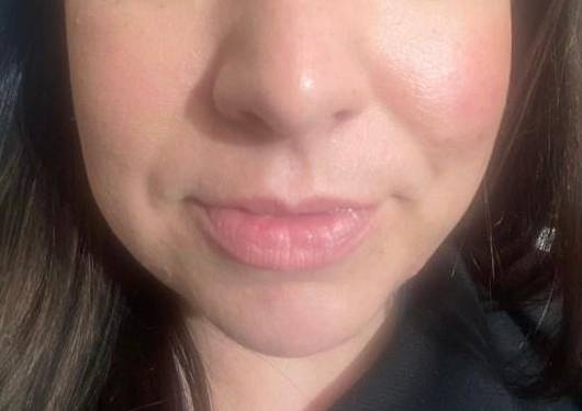 33 year old Before and After Lip Filler, Carmel, IN Before