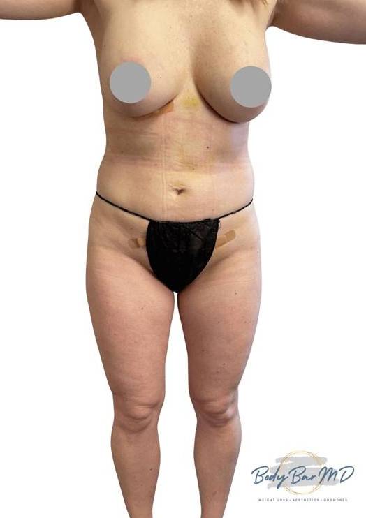 28 year old wanted larger breasts and less abdominal fat After