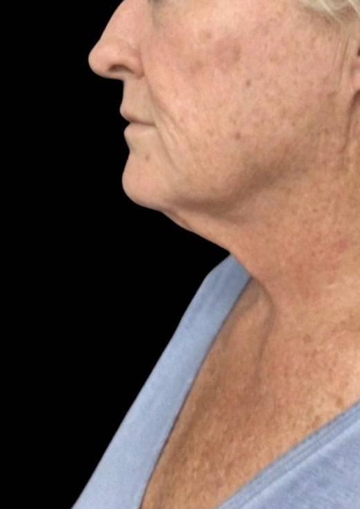 61 year old wanted to get rid of unwanted fat under her chin- Terre haute, IN Before