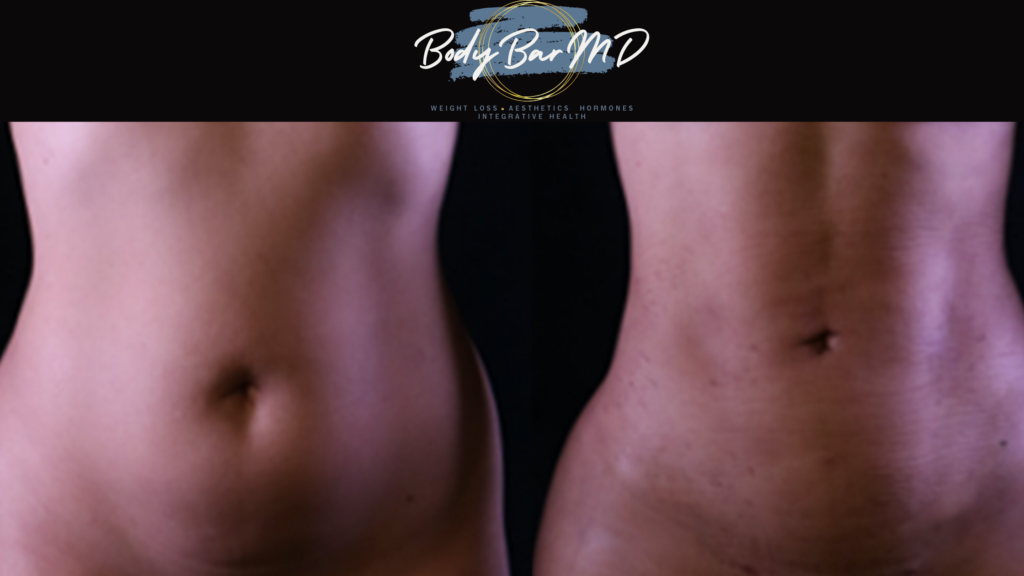 Before and after image of a patient's midsection showing visible fat reduction and skin tightening after Quantum Ignite treatment at Body Bar MD.