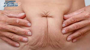 Close-up of a person holding excess skin on their abdomen, showcasing the effects of weight loss or aging.