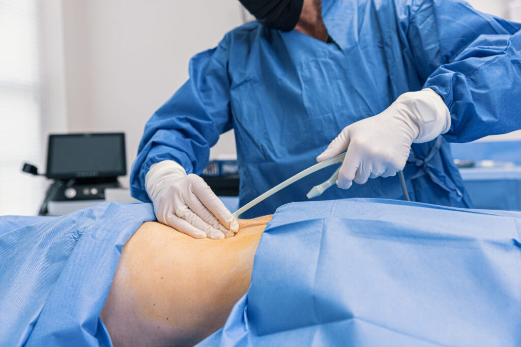 A provider performs lipo near me in Terre Haute